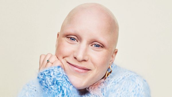 Veronique heeft alopecia