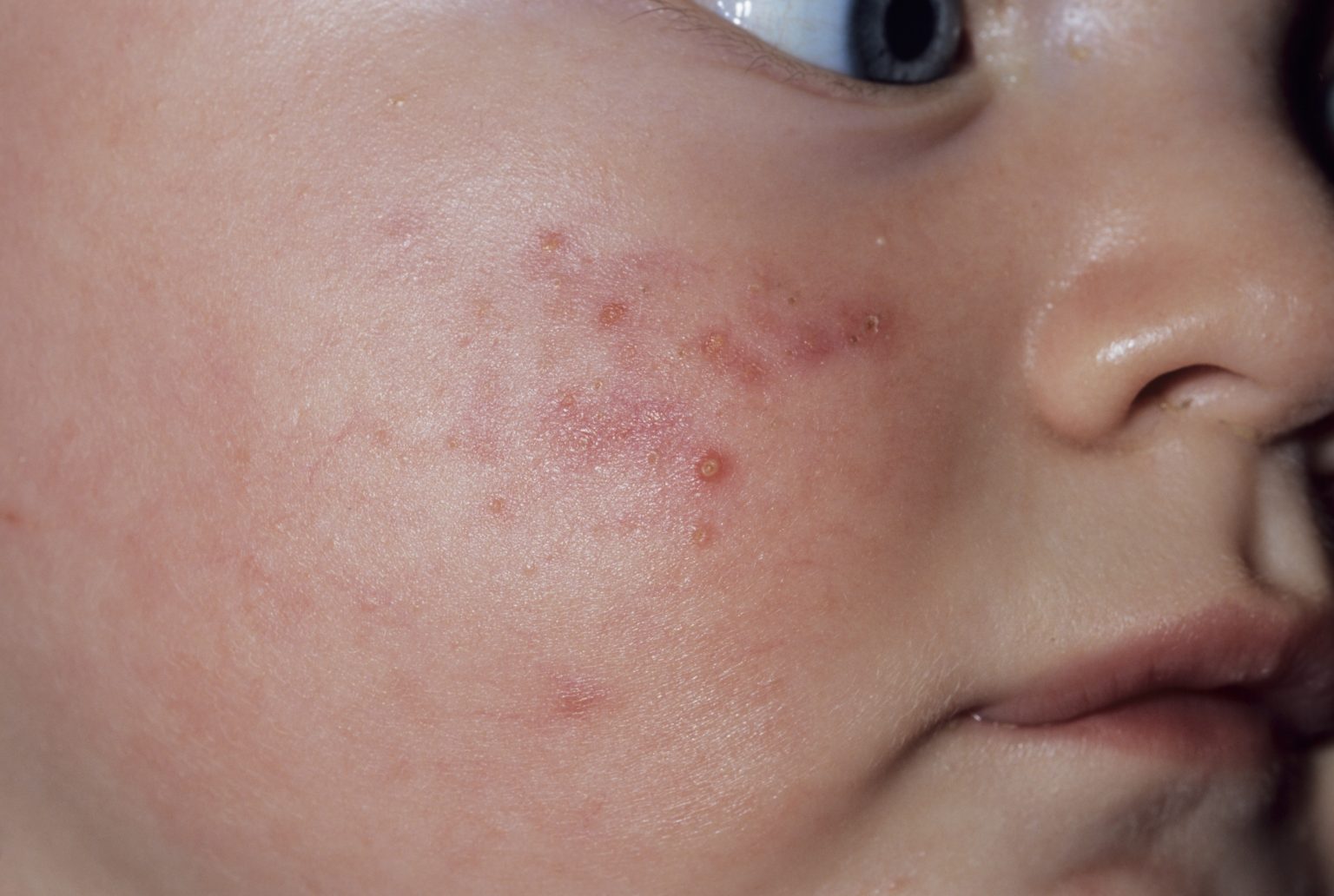 Puistjes Pukkels En Mee Eters Dit Moet Je Weten Over Baby Acne Linda Nl