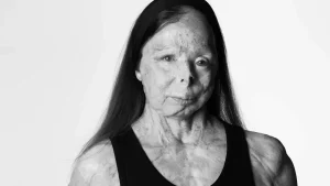 Thumbnail voor Patricia werd slachtoffer van zuuraanval: 'Mijn arm smolt als aspirine'
